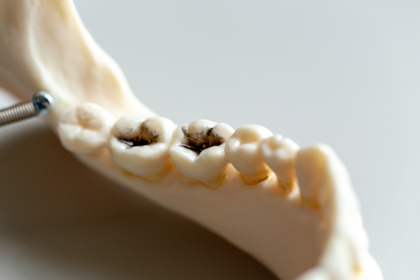 Root Canal Vs  Extraction: Make The Right Choice For Your Oral Health